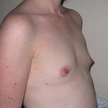Side view of patient before Adbominoplasty Surgery